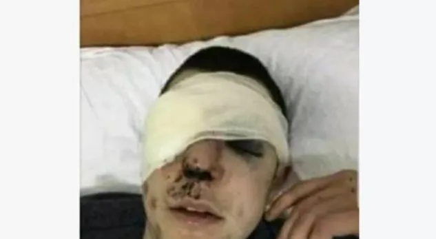 Kumanovë, rrahen dy të rinj deri në përgjakje
